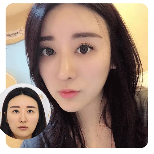 朗妍醫(yī)美 雙眼皮