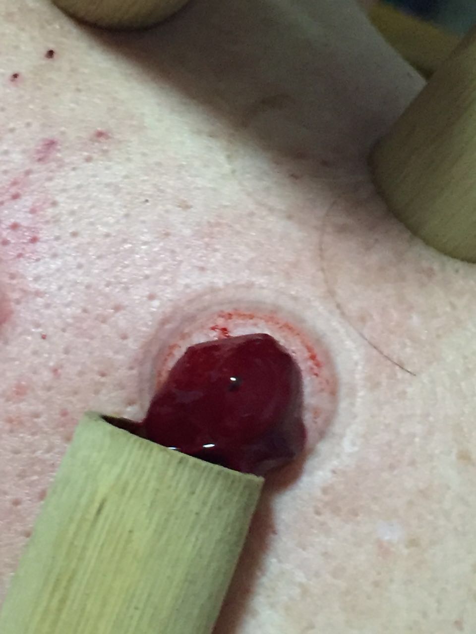 国家非物质文化遗产 中药竹罐疗法